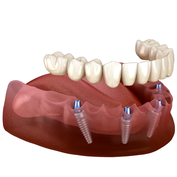 All-on-4 Implants